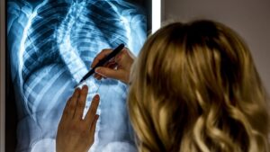 Can a Chiropractor Help with Scoliosis? Non-Surgical Options